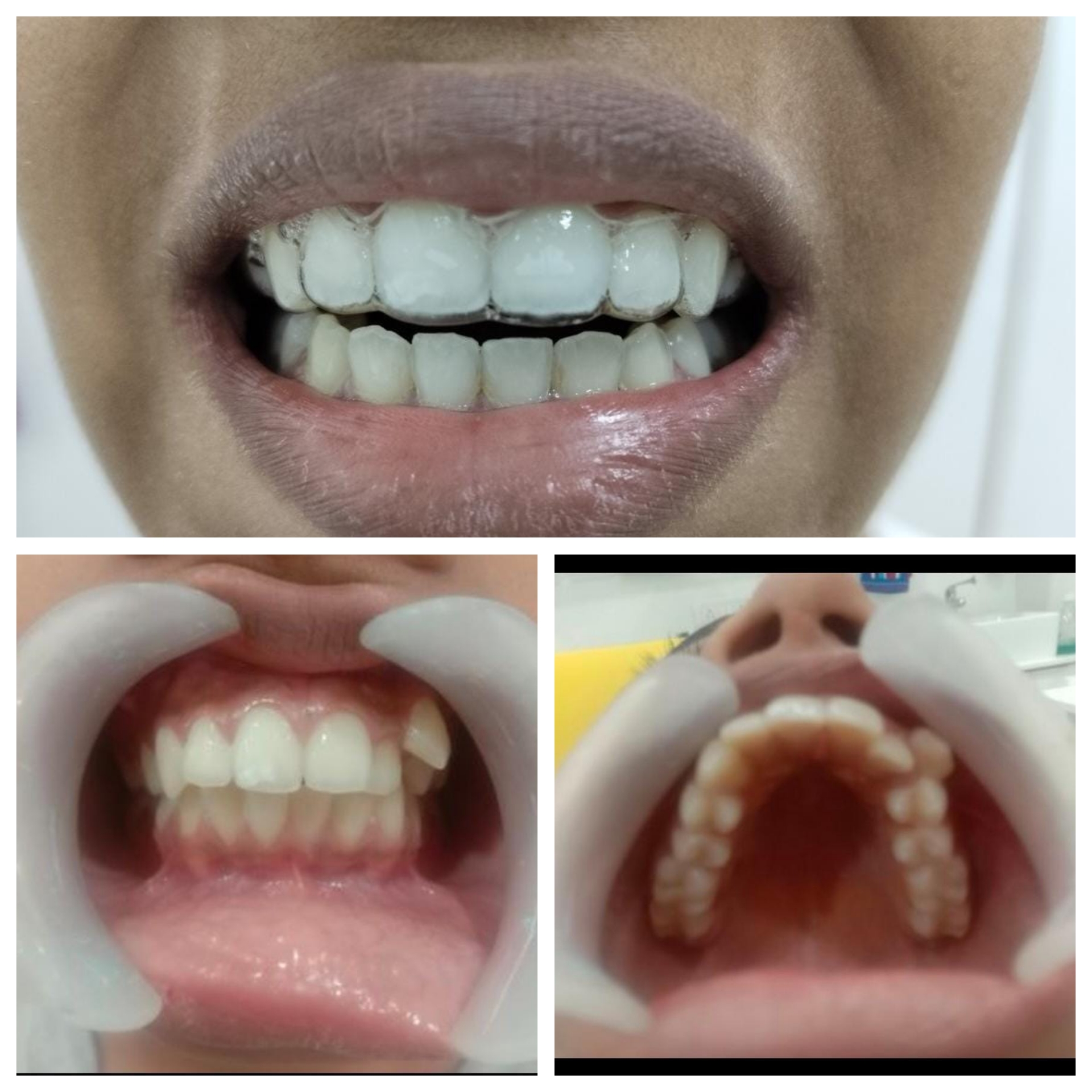 Before and After Smile 1